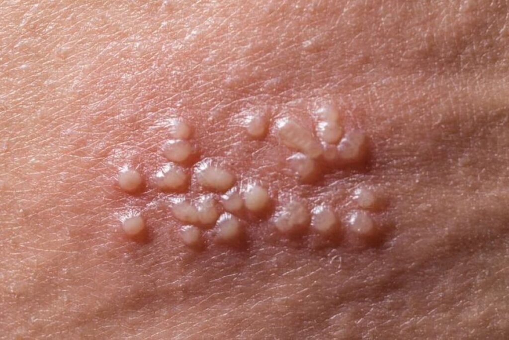 Herpes simpleks lezyonları nedir?