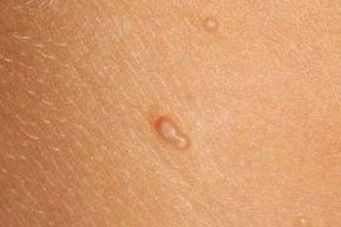 Moluscum contagiosum nasıl tanınır?