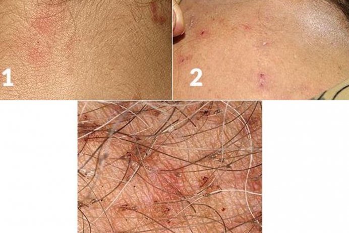Pediculosis nasıl tanınır?