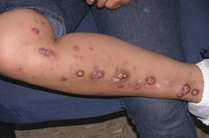 Prurigo nodularis nedir?