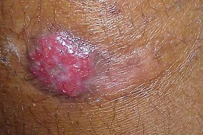 Pyoderma nasıl tanınır?