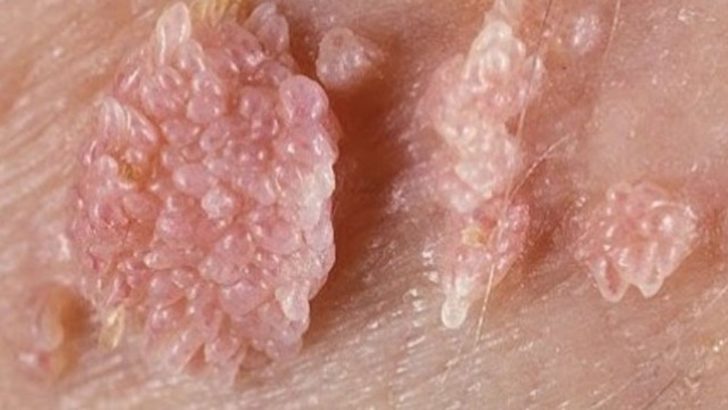 Genital siğiller nasıl bulaşır?