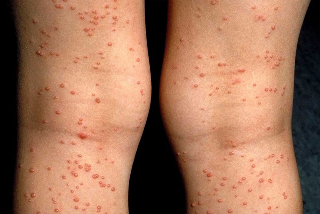 Erkeklerde HIV belirtileri