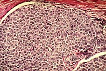 Kanser hücresinin görüntüsü
