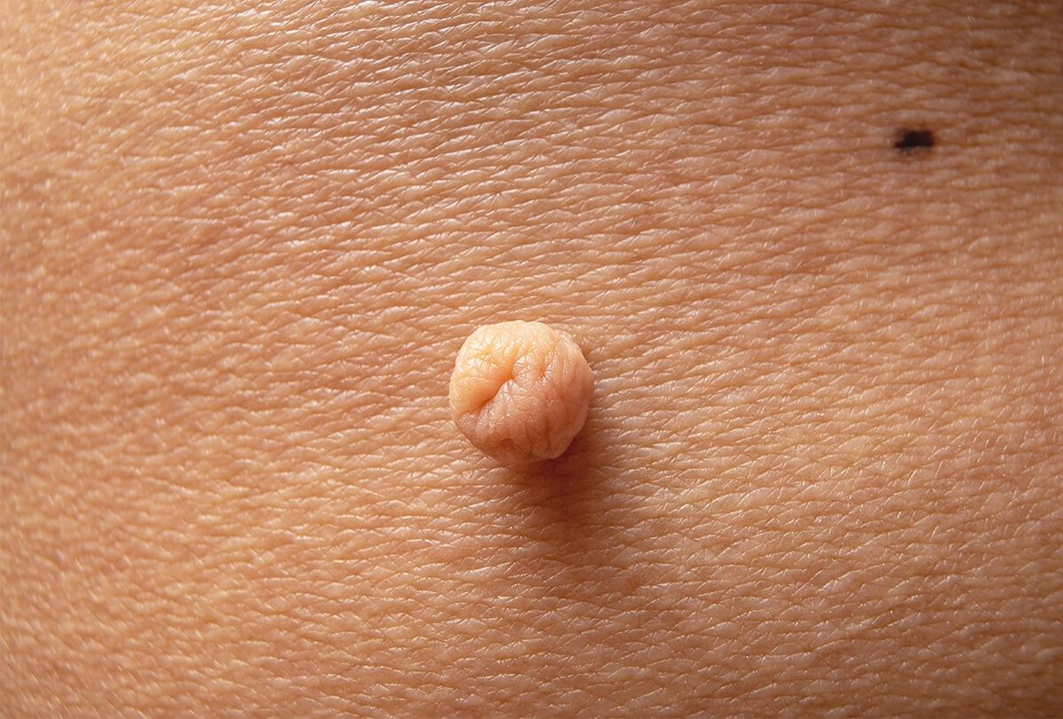 Cilt etiketi nedir? Cilt etiketi doğal nasıl çıkartılır?