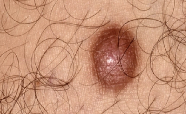 Tümör veya Dermatofibrom nedir?