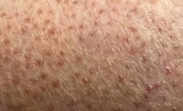 Keratosis Pilaris nedir kısaca, Keratosis Pilaris neden olan nedir?