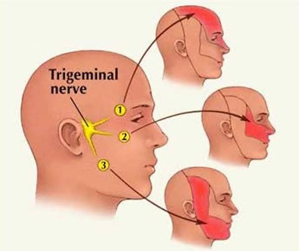 Trigeminal nevralji nasıl tedavi edilir?