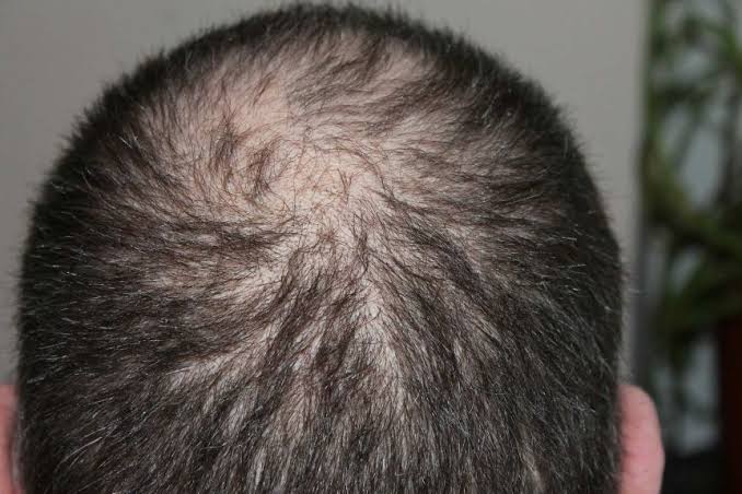 Testosteron ve saç dökülmesi arasındaki bağlantı