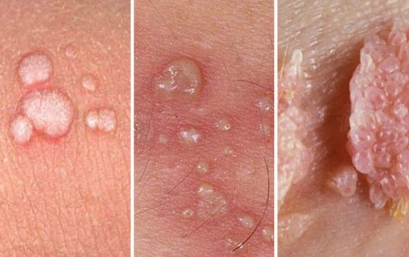 HPV ve siğiller! Sadece estetik bir problem mi?