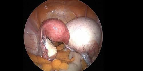 Vajinal kistler nedir? gerçekleri kontrol edin