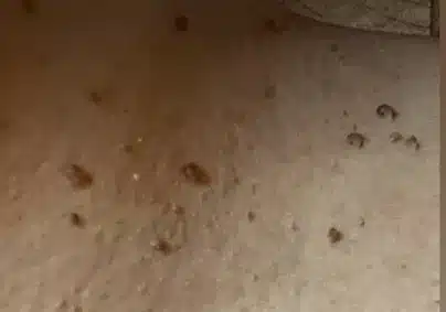 Boyundaki siğiller neden çıkar? Altta yatan sağlık sorunlarının işaretleri