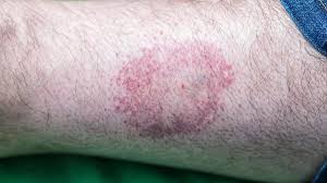 Lyme hastalığı tehlike saçıyor