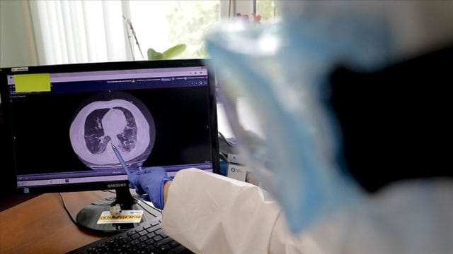 Dural Arteriovenöz Fistül (DAVF) hakkında sık sorulan sorular